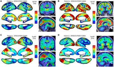 APOE3 Christchurch modulates β-catenin/Wnt signaling in iPS cell-derived cerebral organoids from Alzheimer’s cases